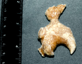 Calcolo di fosfato di calcio